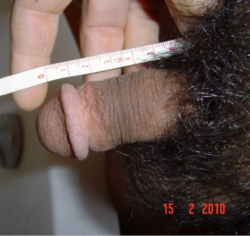 Small circumcised penis